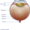 Keratoprothese