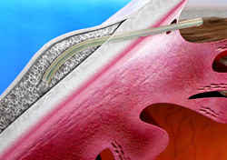 Illustration eines XEN-Glaukom-Implantats