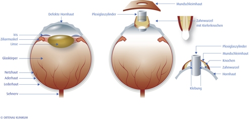 Schaubild zur Keratoprothese